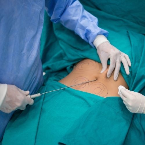 Liposukcja ultradźwiękowa