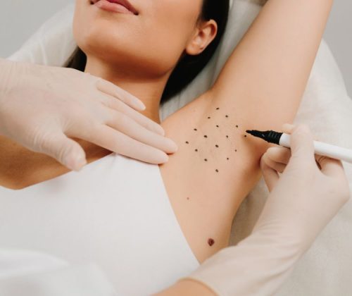 leczenie nadpotliwości pach