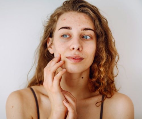 przebarwienia na twarzy