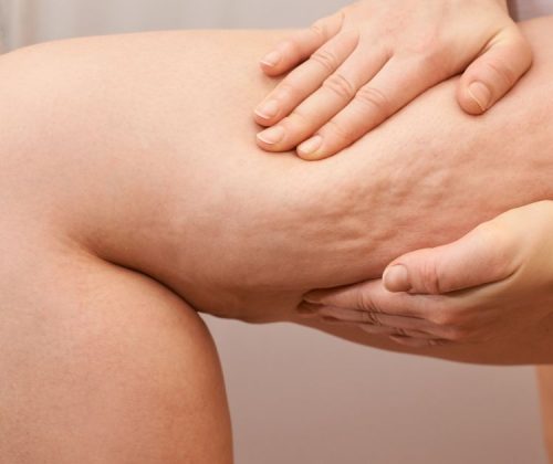 usuwanie cellulitu we Wrocławiu